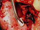 Eine Lebend-Organspende ist bei der Niere sowie bei einem Teil der Leber möglich.
