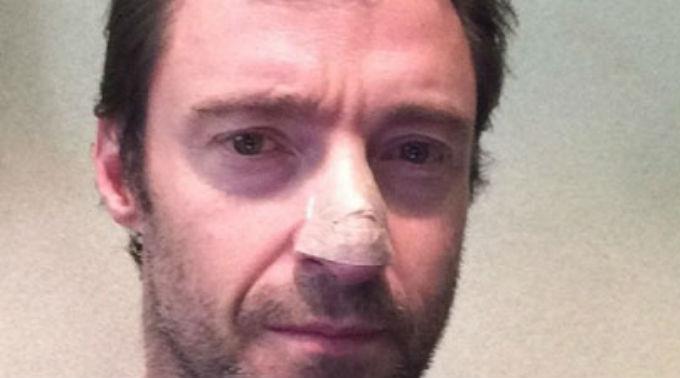 Hugh Jackman teilte seinen Fans auf Instagram mit, dass er wegen Hautkrebs behandelt wurde.